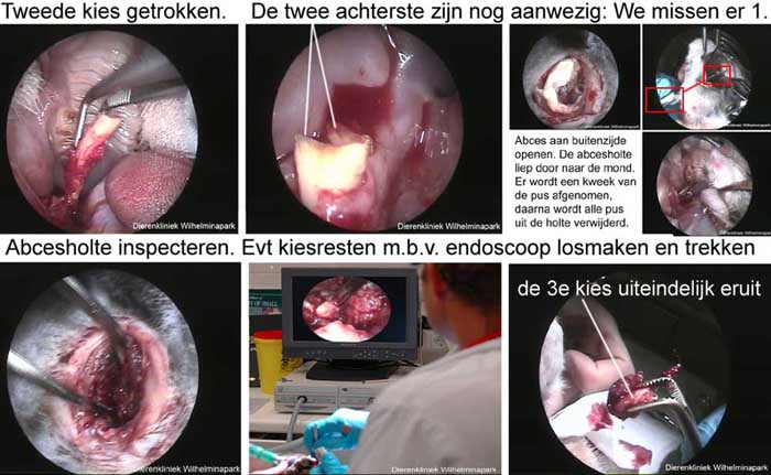 Kies trekken van buiten af met hulp van de endoscoop